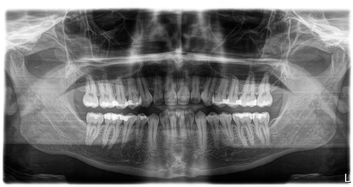 A panoramic dental X-ray showing a full set of teeth